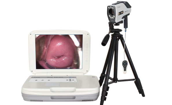 便攜式電子陰道鏡的特點